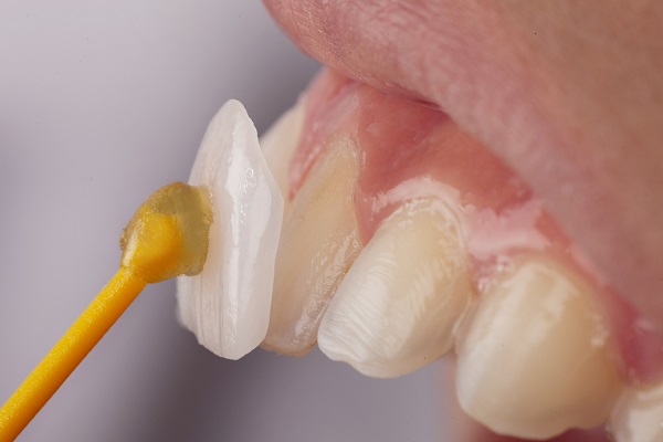 How Dental Veneers Can Strengthen Your Teeth