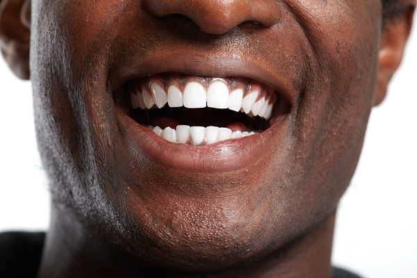 Tips For Teeth Whitening Aftercare